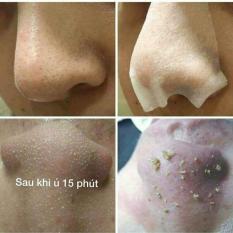 Ủ Mụn OHIO Hangul lấy Nhân Mụn bao dễ dàng hơn thế