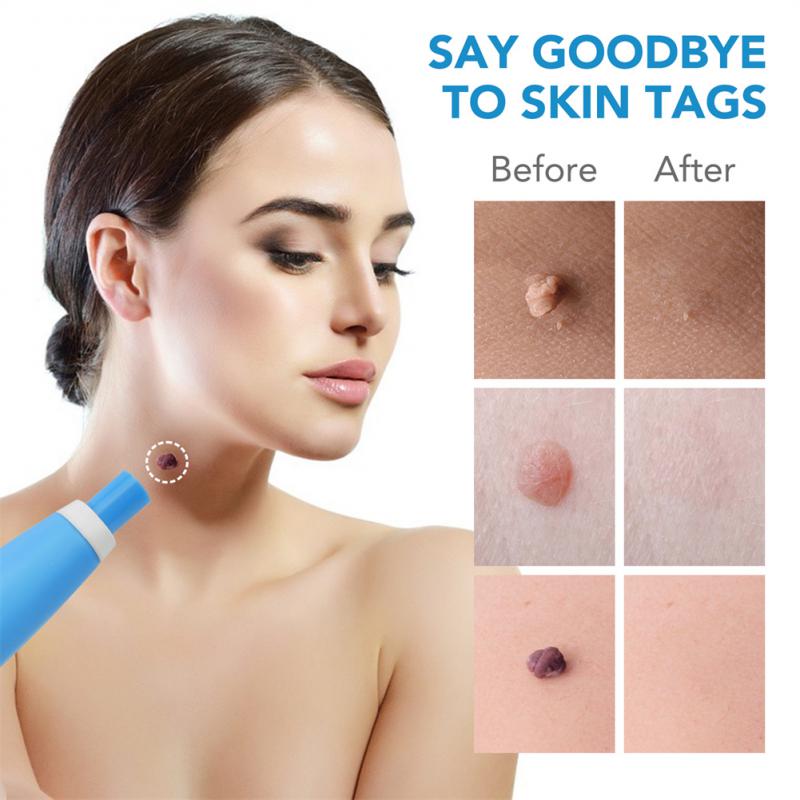 ZZOOI Auto Skin Tag Remover Painless Mole Wart Remover Skin Tag Removal Kit With Cleansing Swabs Facial Beauty Tool Home...