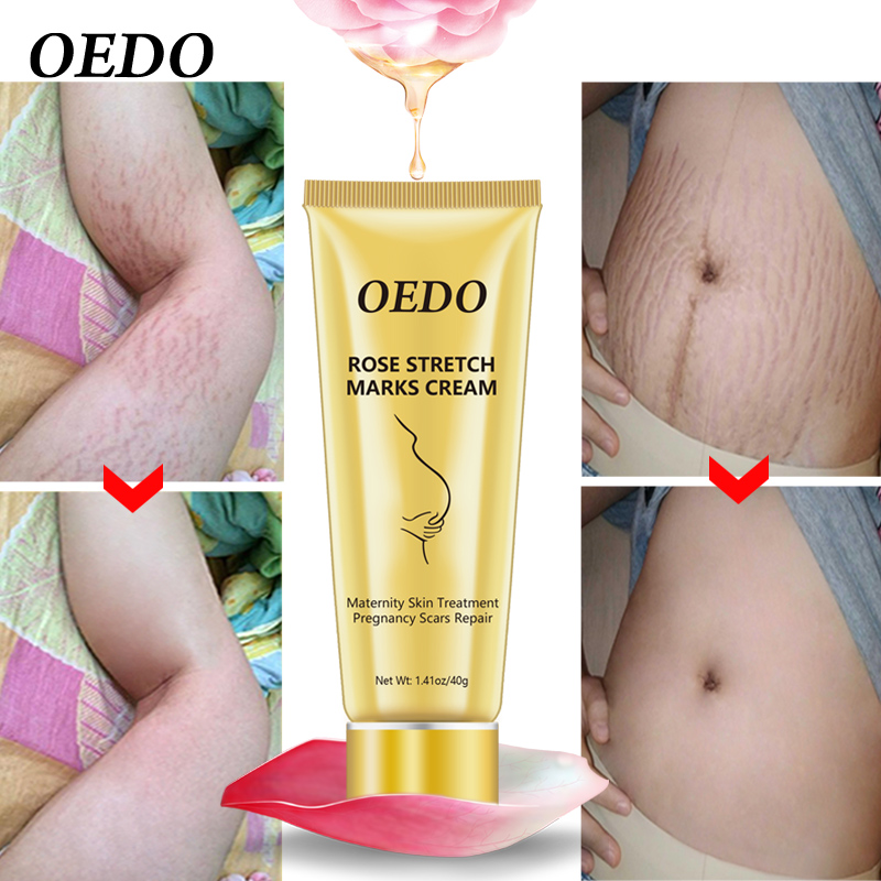 OEDO Rose loại bỏ vết rạn da khi dậy thì hoặc do mang thai chăm sóc da mềm mại và...
