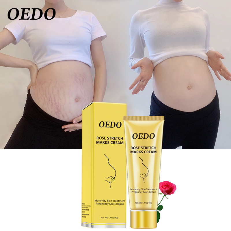 OEDO Rose loại bỏ vết rạn da khi dậy thì hoặc do mang thai chăm sóc da mềm mại và...