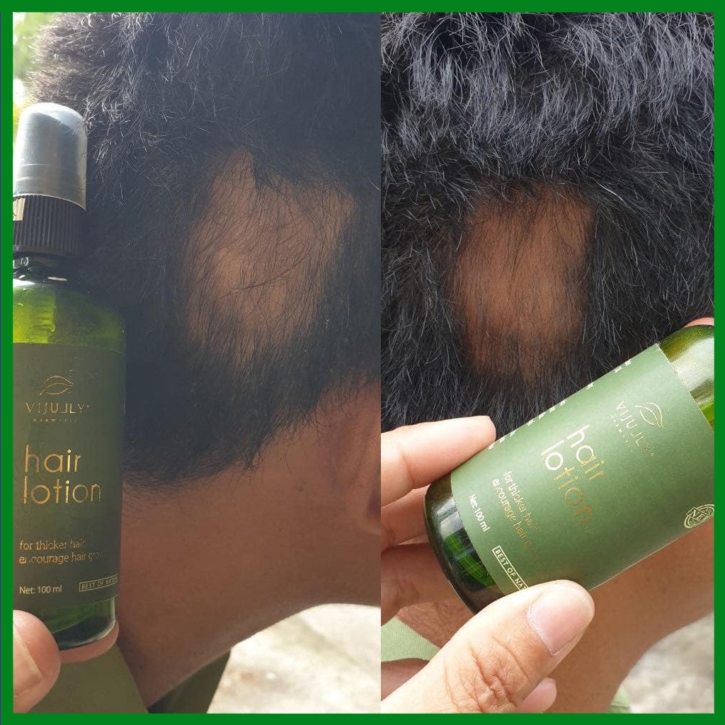 [CHÍNH HÃNG] Tinh Dầu Bưởi Kích Mọc Tóc VI JULLY Hair Lotion 100 ml, giúp giảm rụng tóc, kích thích...