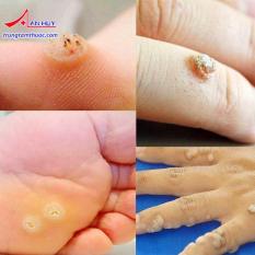 Đặc Trị Mụn Cóc, Mụn Cơm, Mụn Mắt Cá Chân bv da liễu