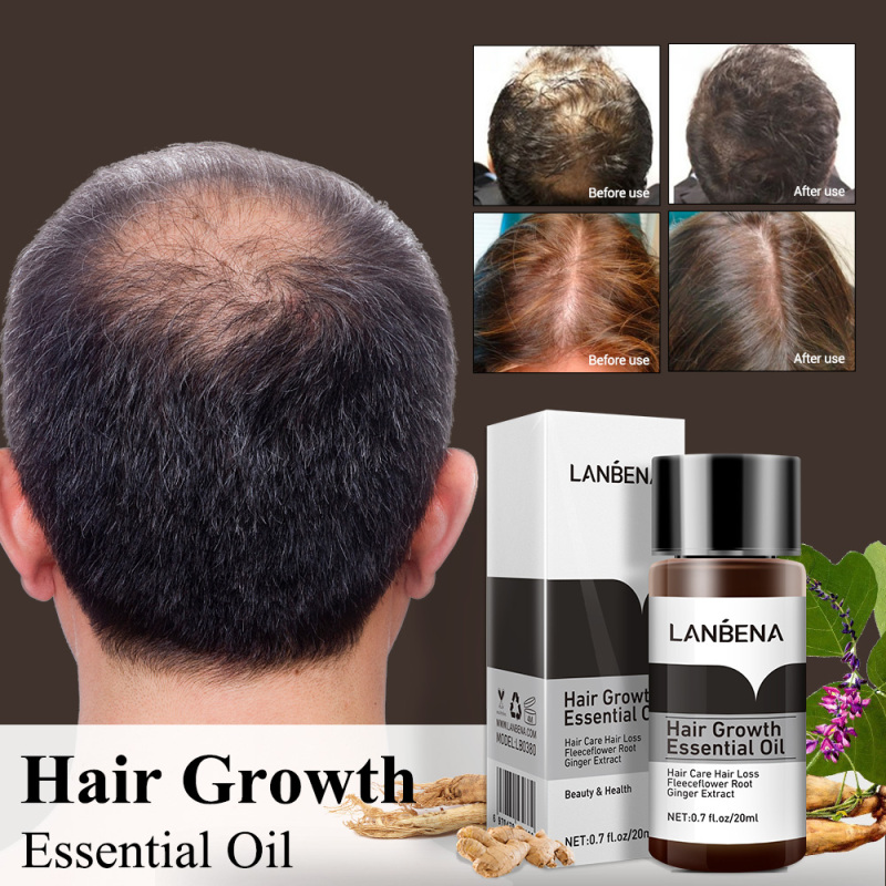 LANBENA Tinh dầu gừng thảo mộc giúp mọc tóc dưỡng tóc ngăn ngừa rụng tóc 20ml – intl